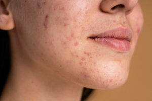 O Que é Acne Hormonal